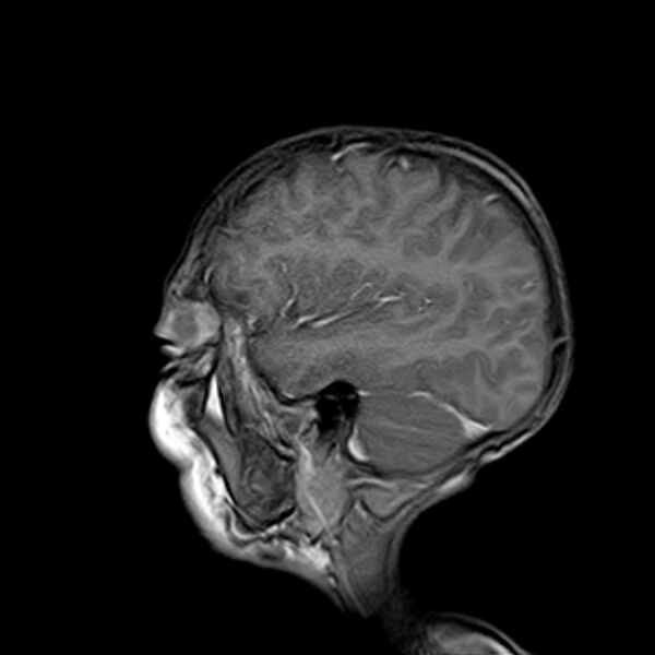 File:Cerebral tuberculoma (Radiopaedia 41152-43932 Sagittal T1 C+ 4).jpg