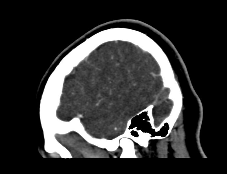 File:Cerebral venous sinus thrombosis (Radiopaedia 59224-66646 Sagittal C+ delayed 60).jpg