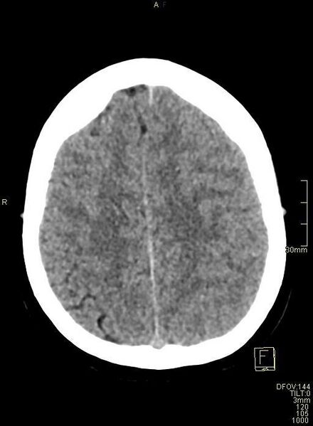 File:Cerebral venous sinus thrombosis (Radiopaedia 91329-108965 Axial non-contrast 39).jpg