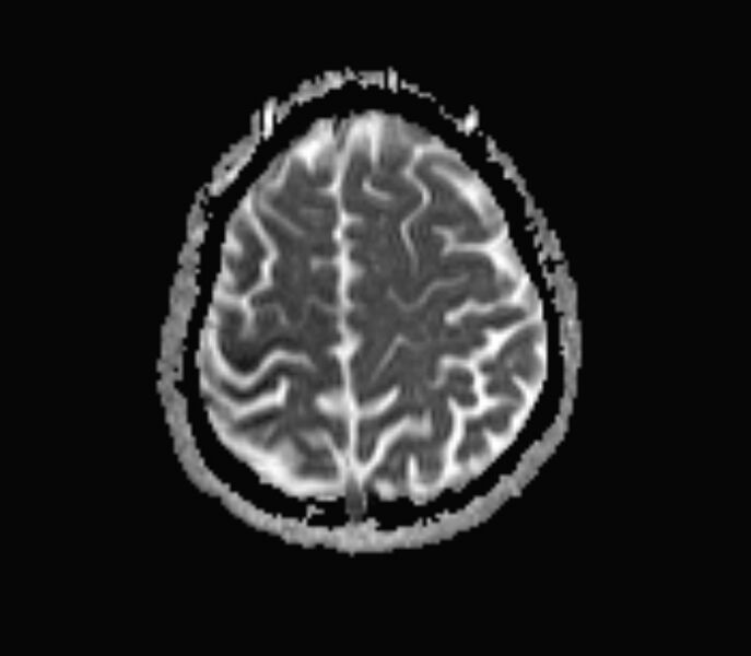 File:Cerebral venous thrombosis (Radiopaedia 71207-81504 Axial ADC 16).jpg