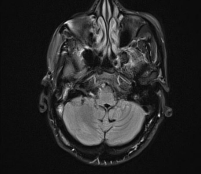 File:Cerebral venous thrombosis (Radiopaedia 71207-81504 Axial FLAIR 7).jpg