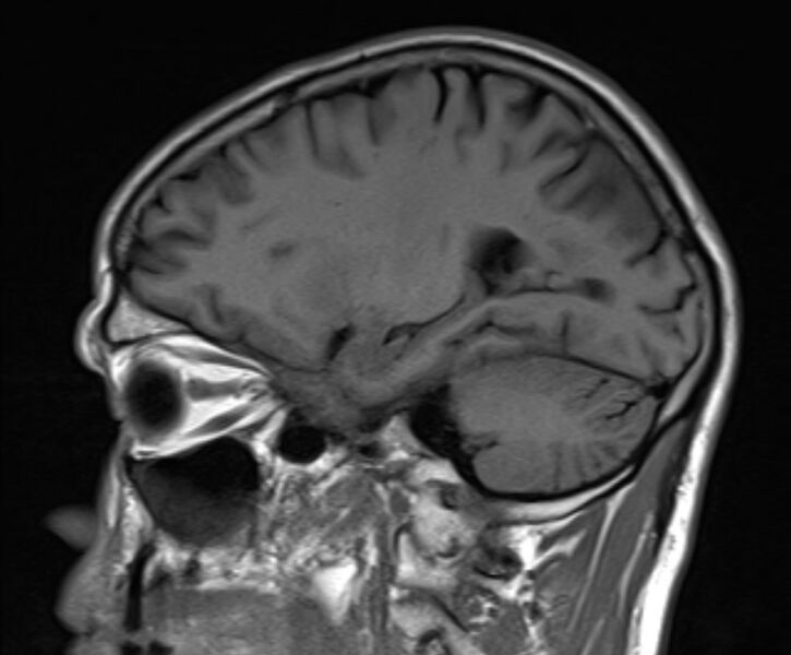 File:Cerebral venous thrombosis (Radiopaedia 71207-81504 Sagittal T1 9).jpg