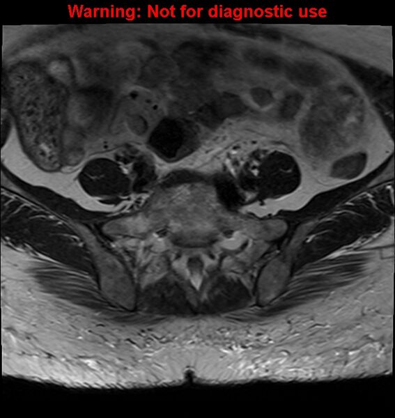 File:Cervical cancer (Radiopaedia 24151-24410 Axial T2 3).jpg