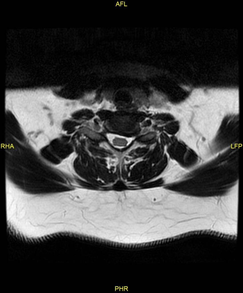 Cervical disc protrusion (Radiopaedia 87147-103415 Axial T2 53).jpg