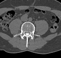 Cervical dural CSF leak on MRI and CT treated by blood patch (Radiopaedia 49748-54996 B 108).png