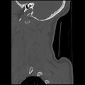 Cervical flexion teardrop fracture with cord hemorrhage (Radiopaedia 32497-33454 Sagittal bone window 3).jpg