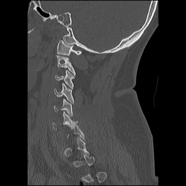 File:Cervical fracture and dislocation with locked facet (Radiopaedia 31837-32780 Sagittal bone window 27).jpg