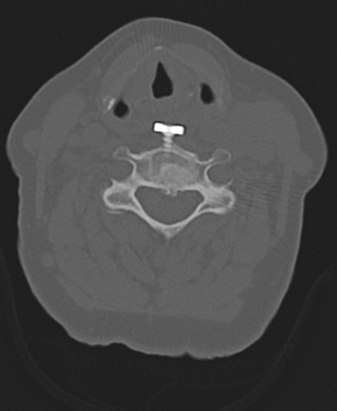 File:Cervical spine ACDF loosening (Radiopaedia 48998-54071 Axial bone window 33).png