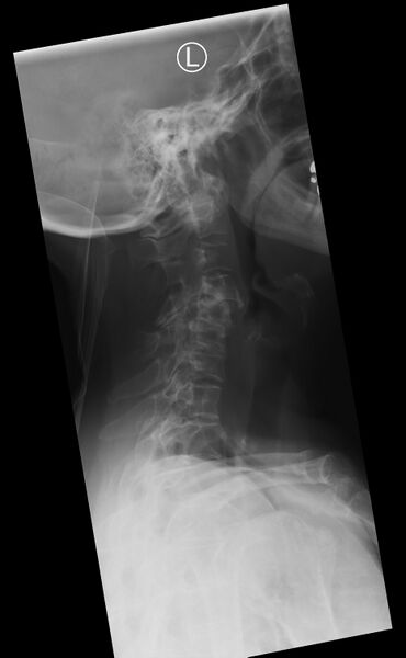 File:Cervical spine dynamic instability in patient with rheumatoid arthritis (Radiopaedia 45107-49087 Neutral 1).jpg