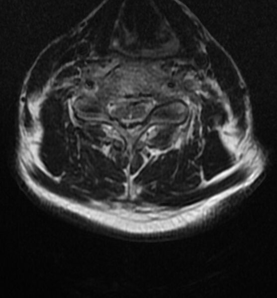 File:Cervical spondylodiscitis (Radiopaedia 81362-95110 Axial T2 11).jpg