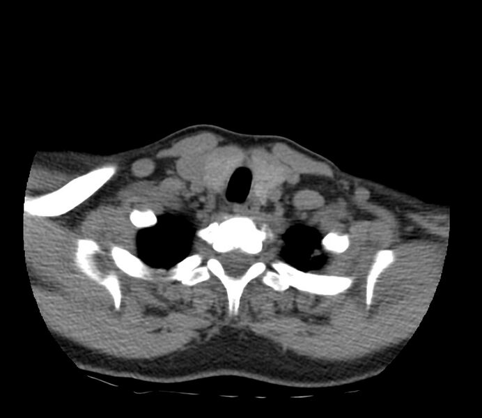 File:Cervical venous malformation (Radiopaedia 22653-22672 Axial non-contrast 47).jpg