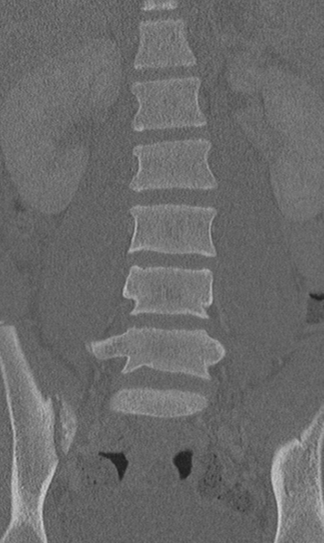 File:Chance fracture (Radiopaedia 40360-42912 Coronal bone window 27).png
