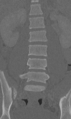 Chance fracture (Radiopaedia 40360-42912 Coronal bone window 27).png