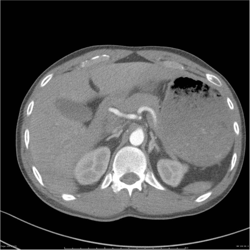 Chest and abdomen multi-trauma (Radiopaedia 26294-26425 A 106).jpg