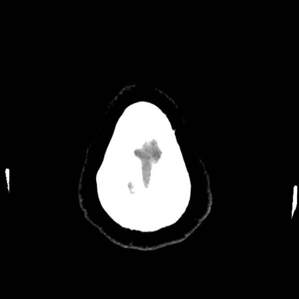 File:Chiasmatic-hypothalamic juvenile pilocytic astrocytoma (Radiopaedia 78533-91237 Axial non-contrast 54).jpg