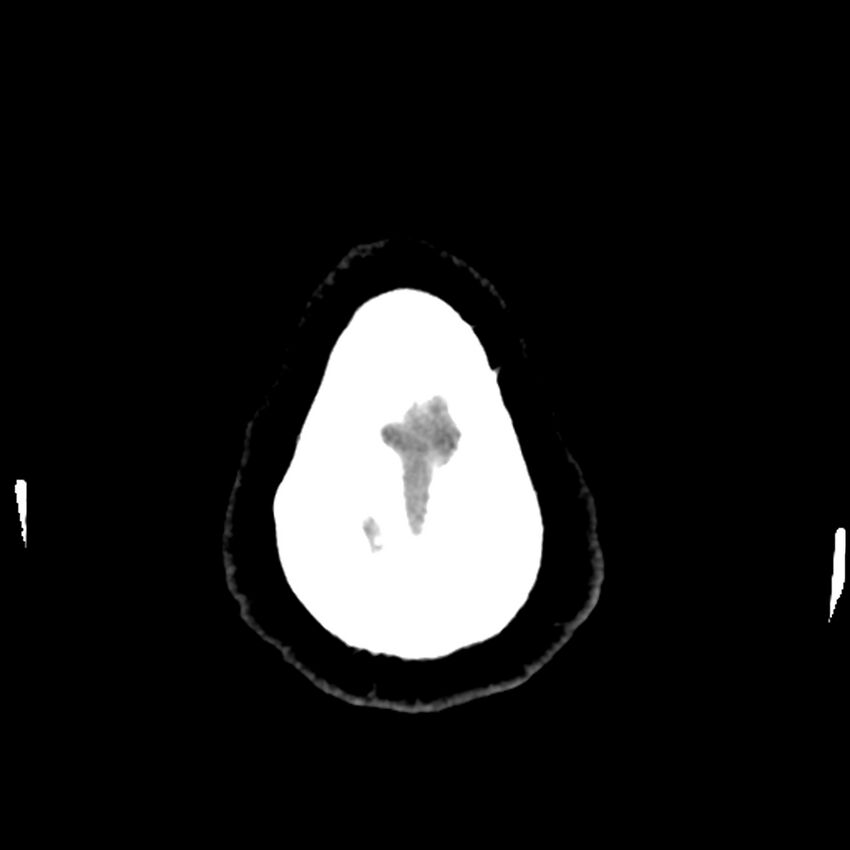 Chiasmatic-hypothalamic juvenile pilocytic astrocytoma (Radiopaedia 78533-91237 Axial non-contrast 54).jpg