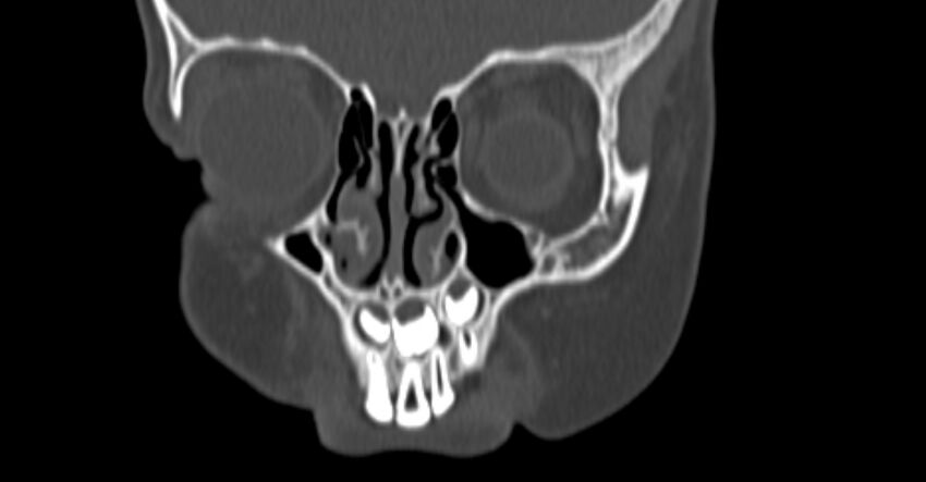 Choanal atresia (Radiopaedia 51295-56972 Coronal bone window 11).jpg