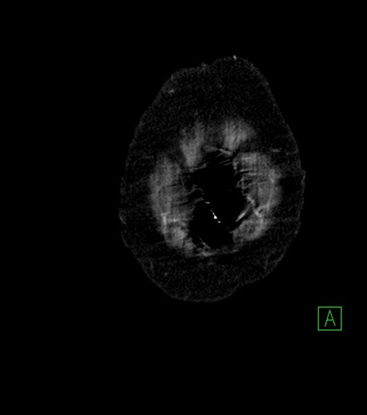 File:Cholangiocarcinoma with cerebral metastases (Radiopaedia 83519-98629 E 2).jpg