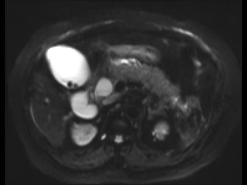 File:Choledocholithiasis causing intrahepatic biliary duct dilation (Radiopaedia 39908-42369 Axial T2 SPAIR 15).jpg