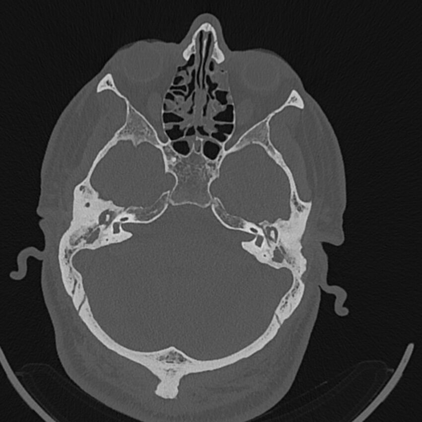 Cholesteatoma (Radiopaedia 68176-77673 Axial bone window 47).jpg