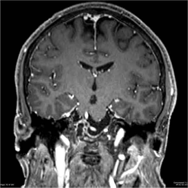 File:Chondrosarcoma of skull base- grade II (Radiopaedia 40948-43654 Coronal T1 C+ 3).jpg