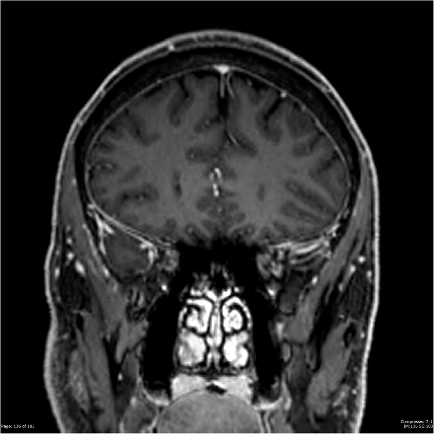 Chondrosarcoma of skull base- grade II (Radiopaedia 40948-43654 Coronal T1 C+ 47).jpg