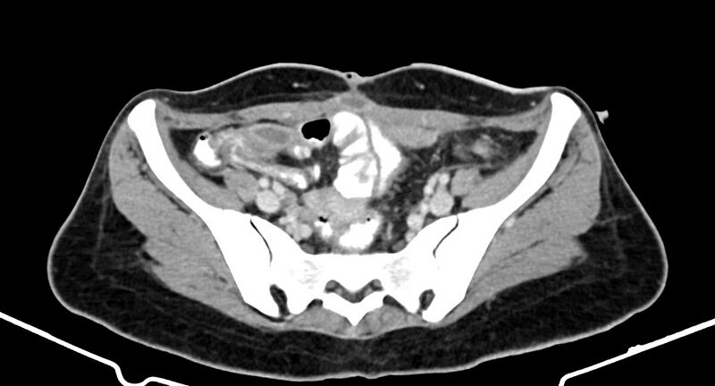 File:Choriocarcinoma liver metastases (Radiopaedia 74768-85766 A 161).jpg