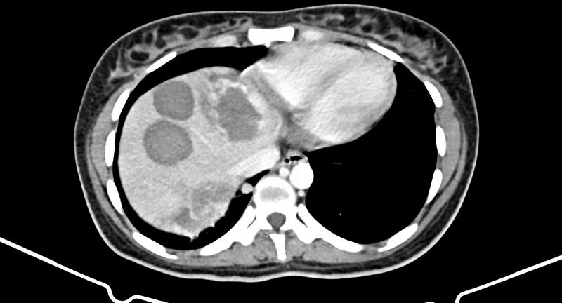 File:Choriocarcinoma liver metastases (Radiopaedia 74768-85766 A 24).jpg
