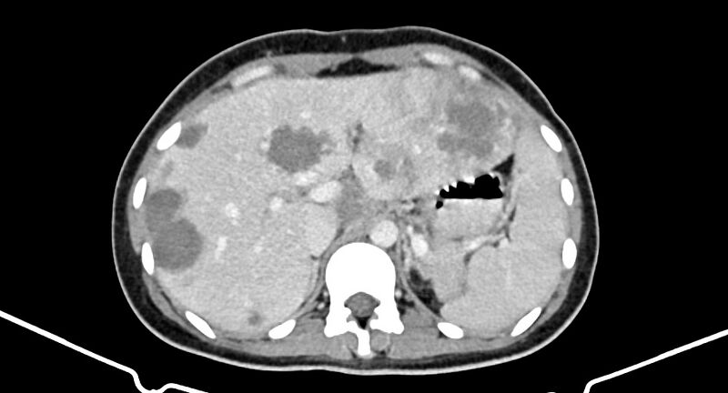 File:Choriocarcinoma liver metastases (Radiopaedia 74768-85766 A 63).jpg