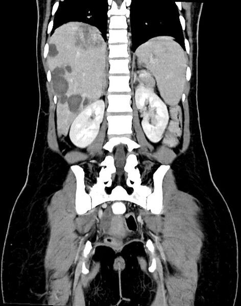 File:Choriocarcinoma liver metastases (Radiopaedia 74768-85766 B 70).jpg
