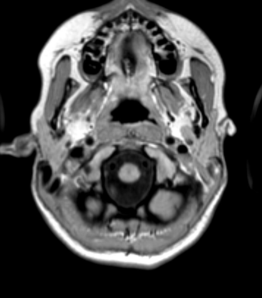 Choroid plexus carcinoma (Radiopaedia 91013-108553 Axial T1 29).jpg