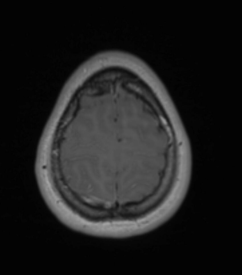 Choroid plexus carcinoma (Radiopaedia 91013-108553 Axial T1 C+ 190).jpg