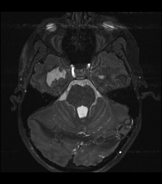 File:Choroid plexus carcinoma (Radiopaedia 91013-108553 Axial T2 CISS 2).jpg