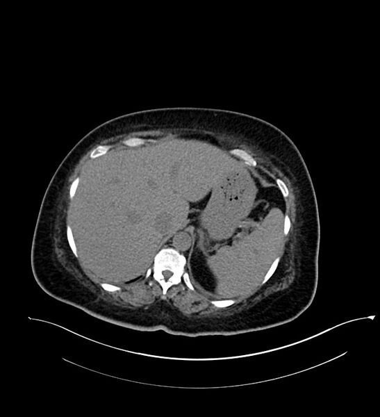 File:Chromophobe renal cell carcinoma (Radiopaedia 84239-99519 Axial non-contrast 40).jpg