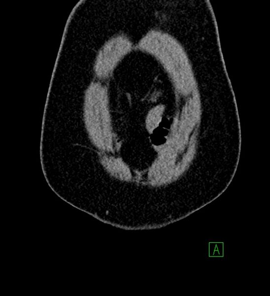 File:Chromophobe renal cell carcinoma (Radiopaedia 84286-99573 Coronal non-contrast 10).jpg