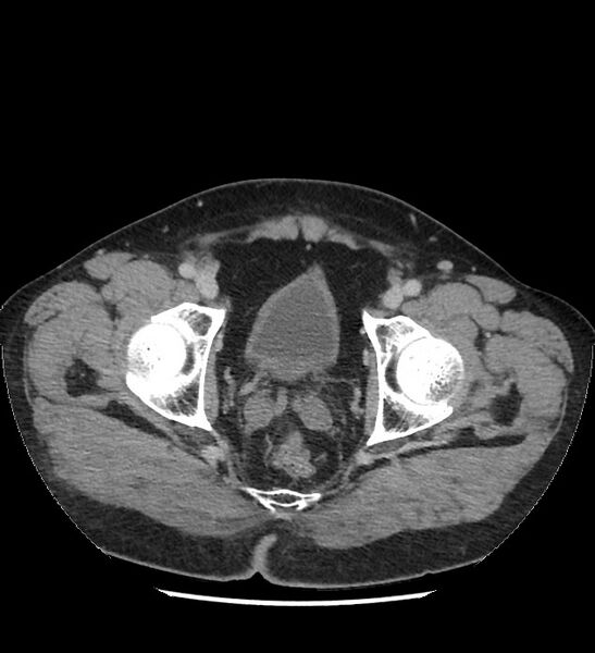 File:Chromophobe renal cell carcinoma (Radiopaedia 86879-103083 C 142).jpg