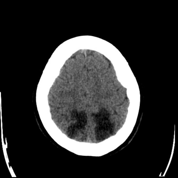 File:Chronic bilateral occipital lobe infarcts (Radiopaedia 31276-31996 Axial non-contrast 35).jpg