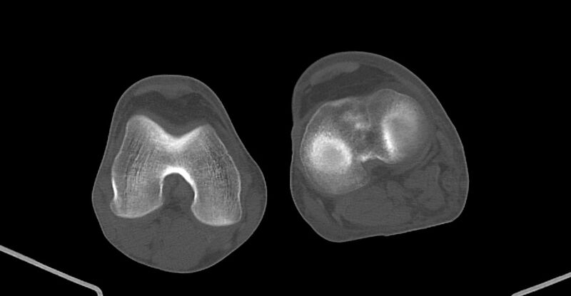 File:Chronic osteomyelitis (with sequestrum) (Radiopaedia 74813-85822 Axial non-contrast 191).jpg