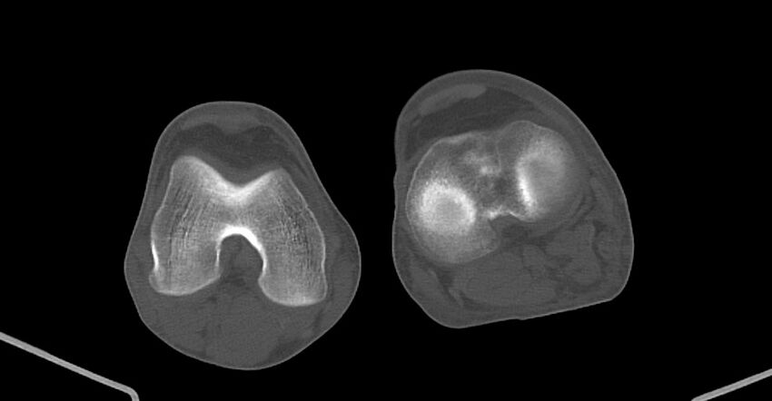 Chronic osteomyelitis (with sequestrum) (Radiopaedia 74813-85822 Axial non-contrast 191).jpg