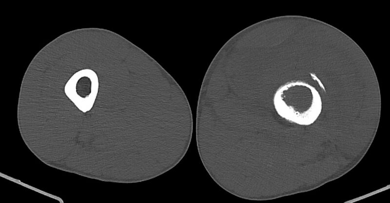 File:Chronic osteomyelitis (with sequestrum) (Radiopaedia 74813-85822 Axial non-contrast 96).jpg