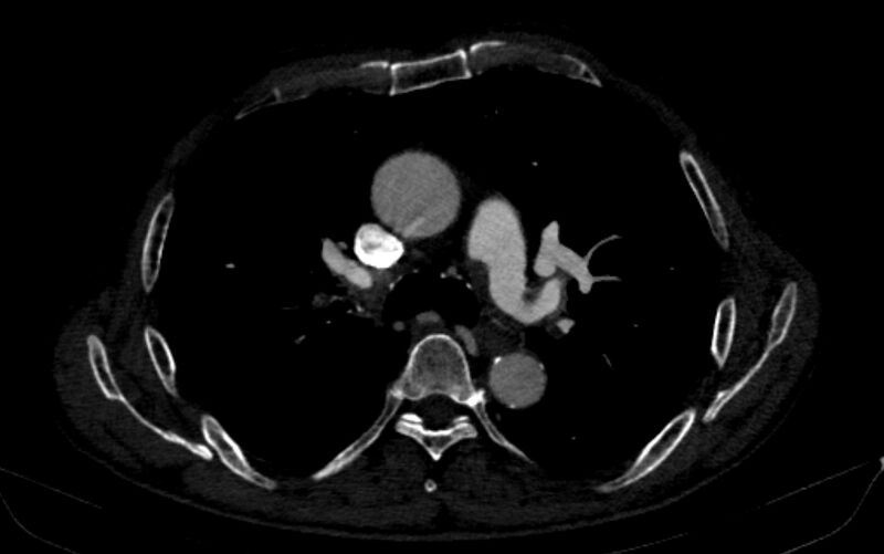 File:Chronic pulmonary embolism (Radiopaedia 91241-108843 B 76).jpg