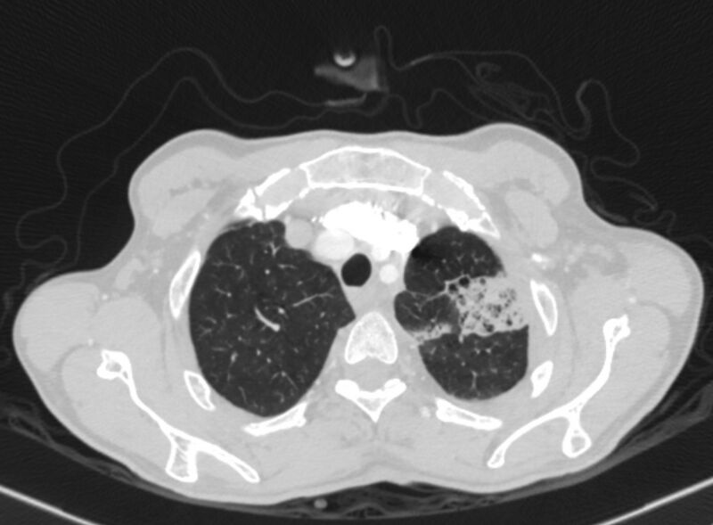 File:Chronic pulmonary embolism with bubbly consolidation (Radiopaedia 91248-108850 Axial lung window 23).jpg