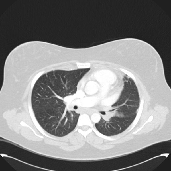 File:Chronic thromboembolic pulmonary hypertension (CTEPH) (Radiopaedia 74597-85531 Axial lung window 24).jpg
