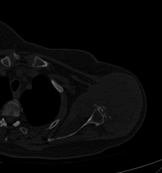 File:Clear cell chondrosarcoma - humerus (Radiopaedia 63104-71612 Axial bone window 38).jpg