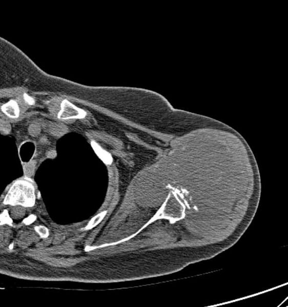 File:Clear cell chondrosarcoma - humerus (Radiopaedia 63104-71612 Axial non-contrast 38).jpg