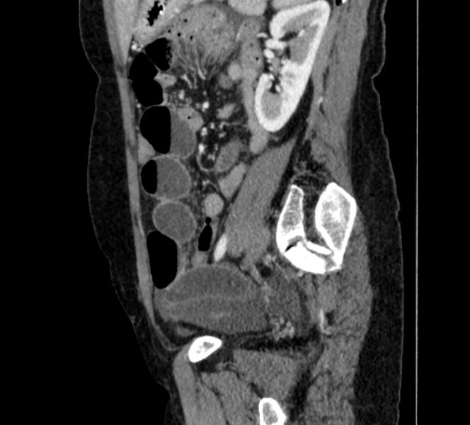 File:Closed loop small bowel obstruction (Radiopaedia 71211-81508 C 112).jpg
