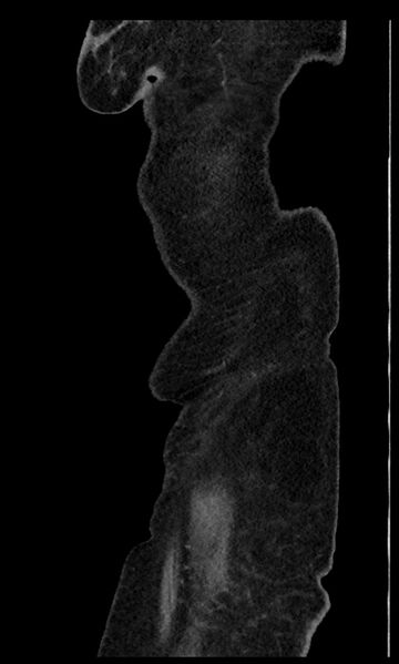 File:Closed loop small bowel obstruction - adhesions (Radiopaedia 59269-66611 C 5).jpg