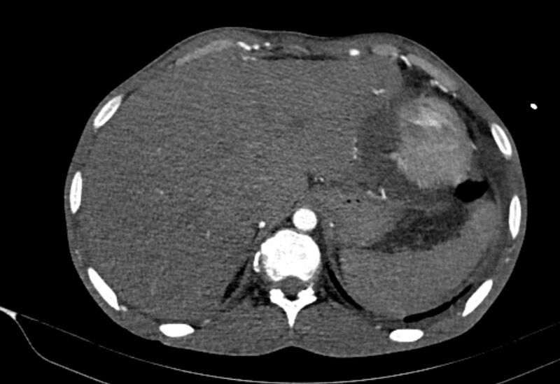 File:Coarctation of aorta with aortic valve stenosis (Radiopaedia 70463-80574 A 217).jpg