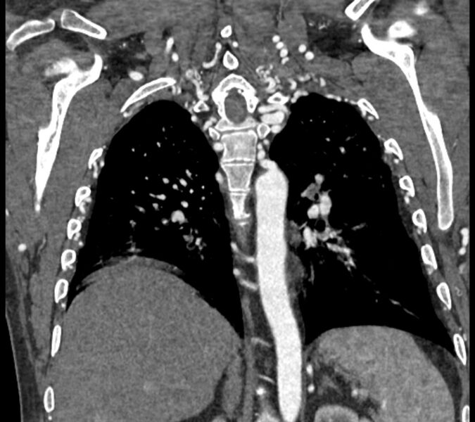 File:Coarctation of the aorta (Radiopaedia 53752-59822 B 56).jpg