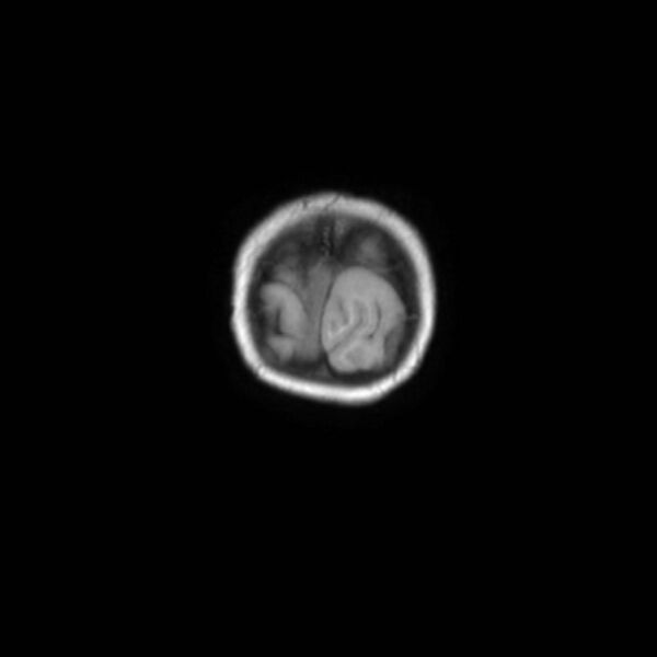 File:Cochlear nerve aplasia - unilateral (Radiopaedia 87910-104413 Coronal T1 53).jpg